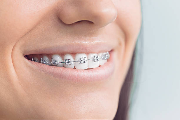 Dental Bonding in Grandview Plaza, KS